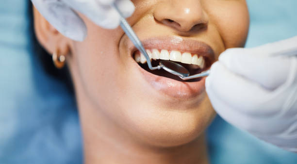 Best Knocked-Out Tooth (Avulsed Tooth) Treatment in Maineville, OH